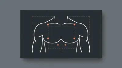 Gynecomastia Surgery (Male Breast Reduction)